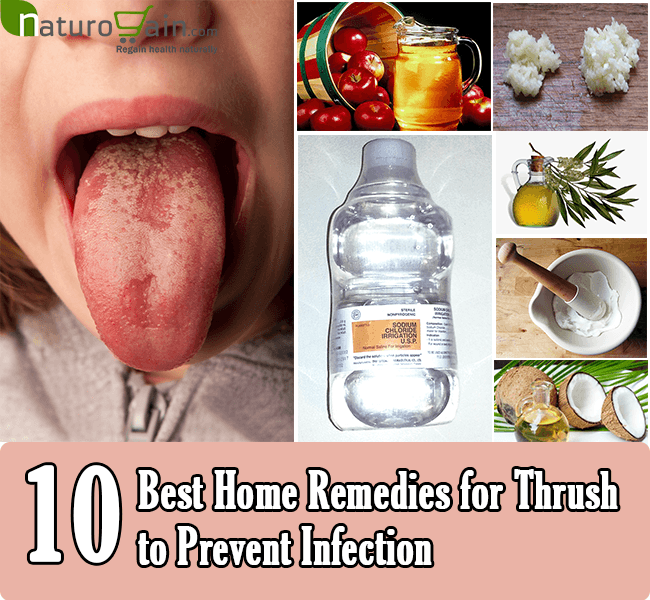 10 Best Home Remedies for Thrush to Prevent Infection