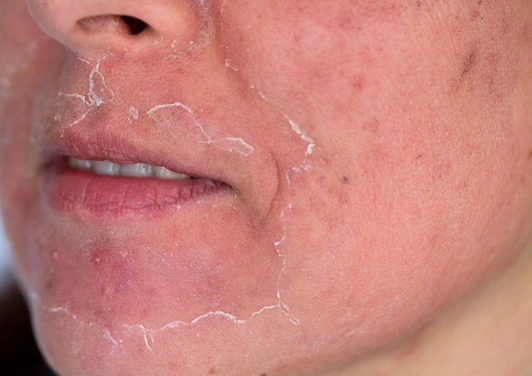 5 Things to do After Your Peel