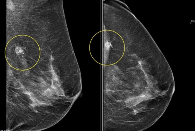 7 Things You Need To Know About Mammography For Breast ...