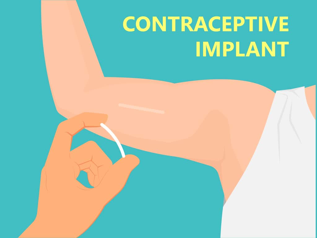 Birth Control Implant (Nexplanon)