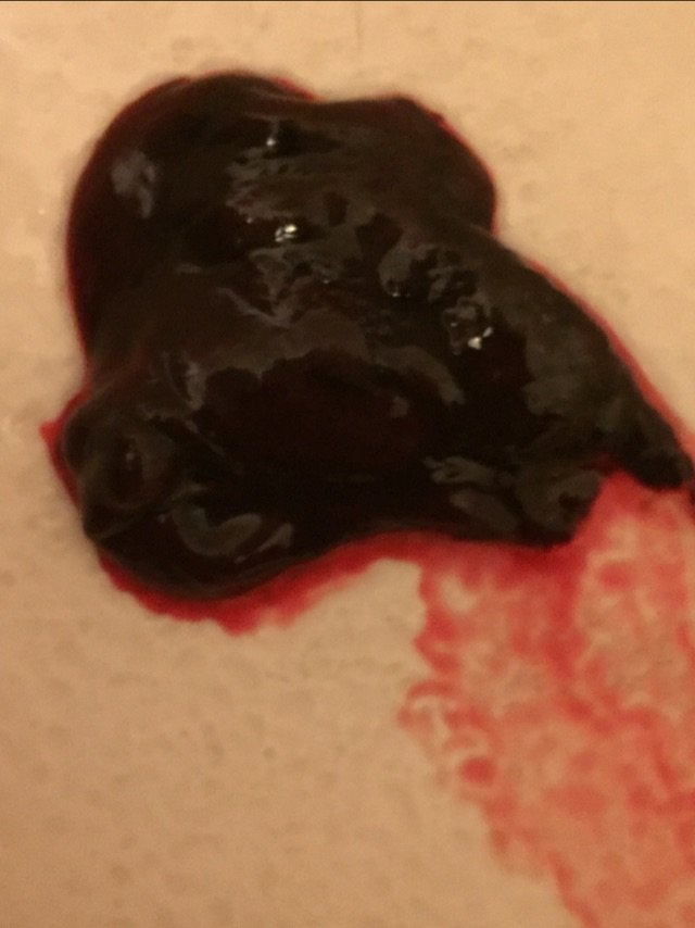 blood clots (PICTURE INCLUDED)