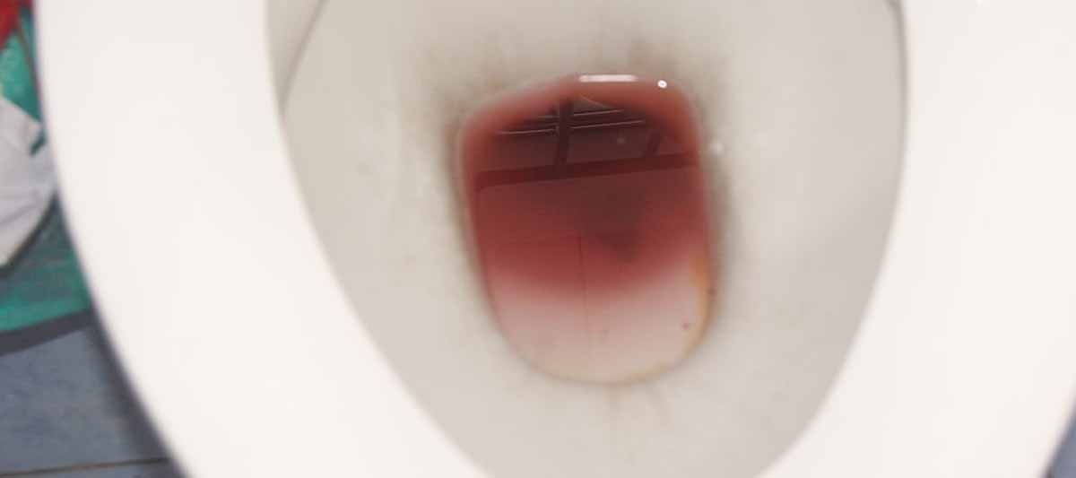 Causes Of Blood In Your Urine (Hematuria)