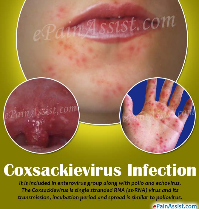 Coxsackievirus Infection