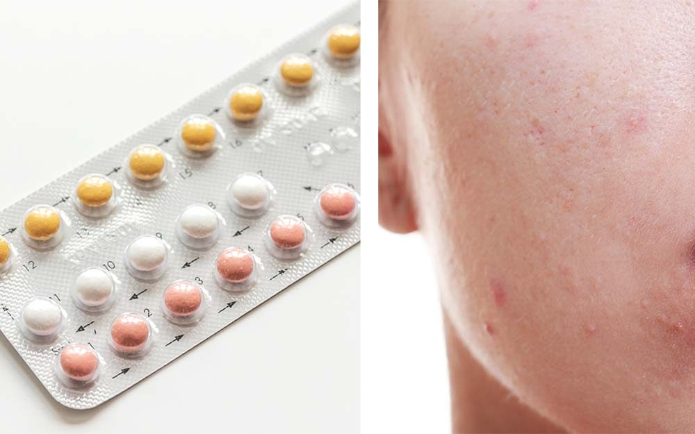 Does Birth Control Help or Hurt Acne? A Dermatologist ...
