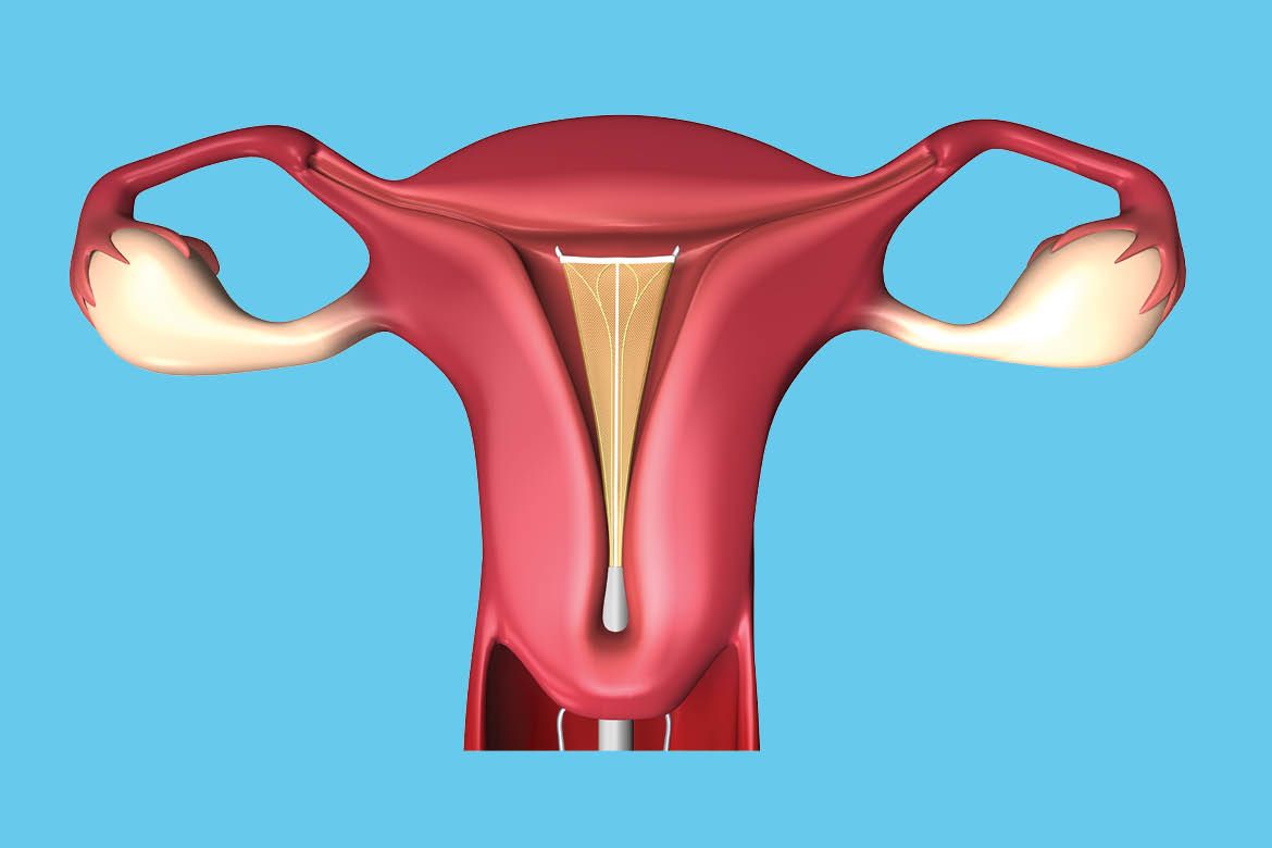 Endometrial Ablation in 2021