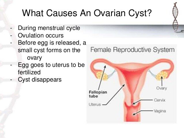 Final ovariancystsgroup7