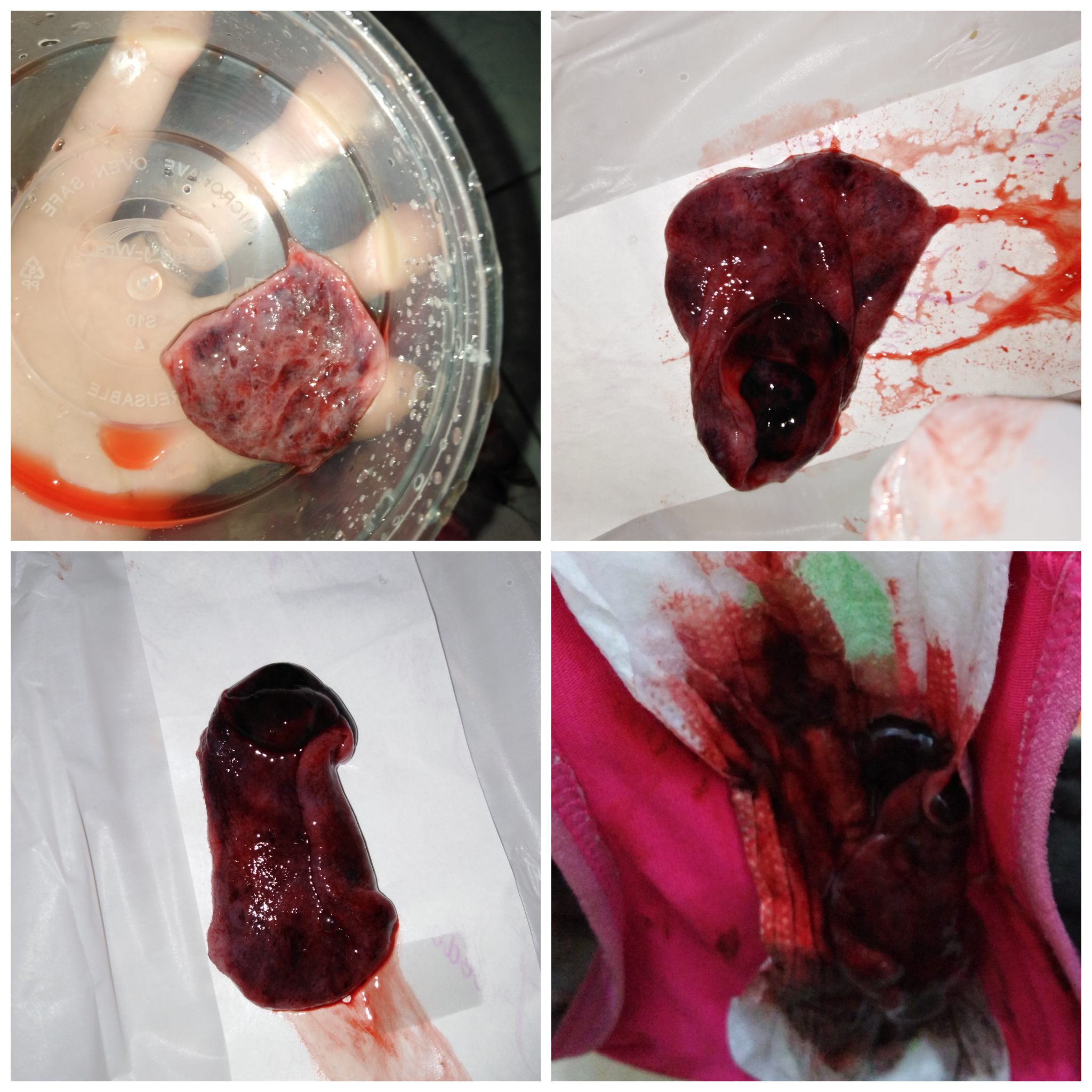 *GRAPHIC IMAGE* Is this implantation bleeding or miscarriage?