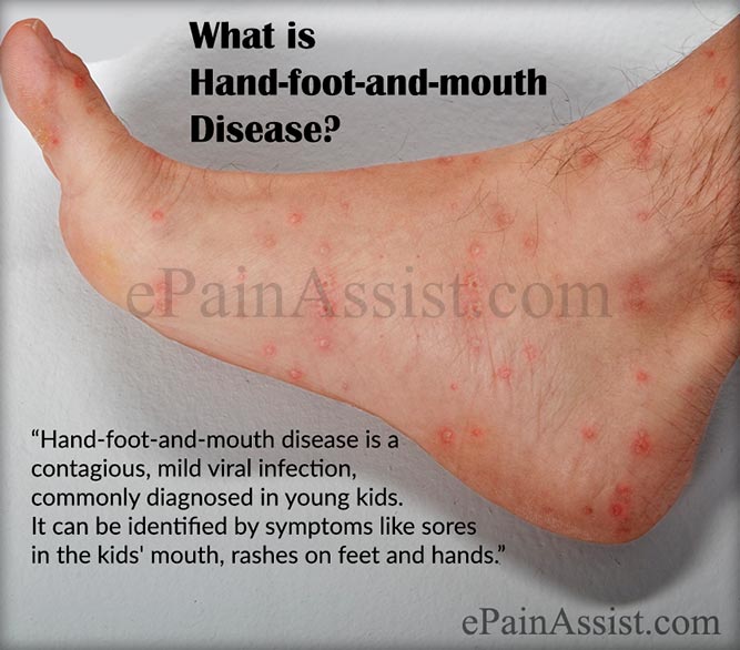 Hand Foot Mouth Contagious Period