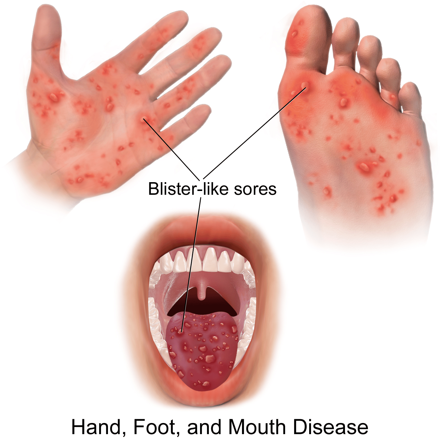 Hand foot &  mouth disease