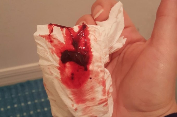 Heavy implantation bleeding experiences
