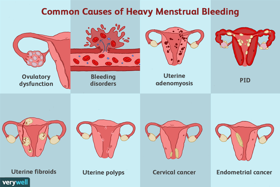 Heavy Menstrual Bleeding (menorrhagia) Causes, Symptoms, Diagnosis