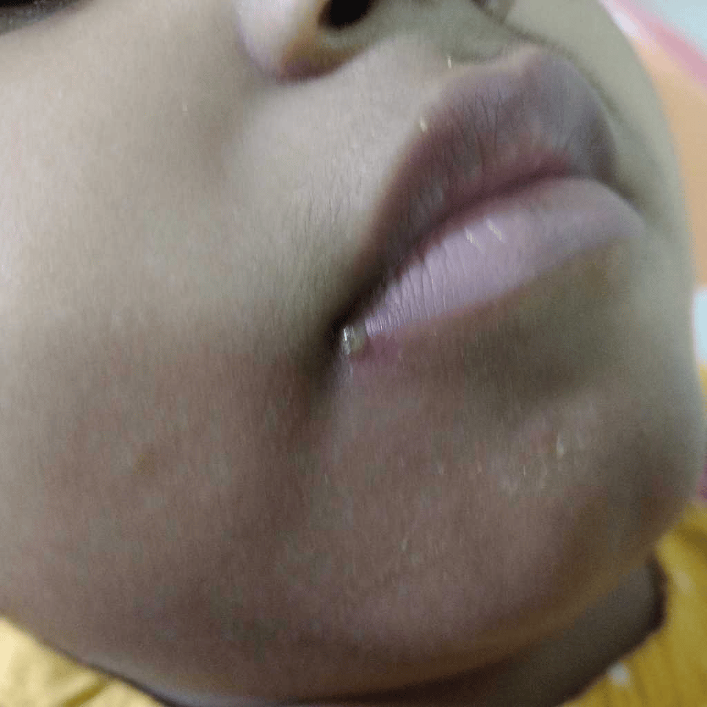 Hi... my son is 1& 1/2months old. he is getting pimples like things on ...