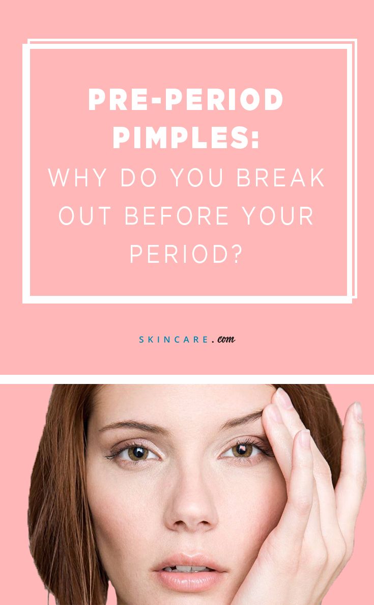 Hormonal Acne: Why Do I Break Out Before My Period?