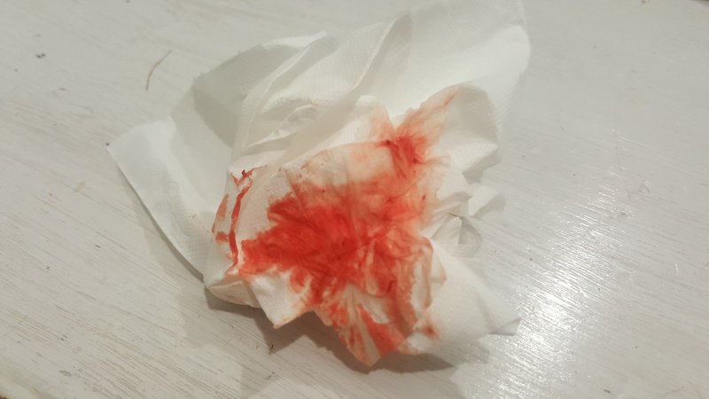 Implantation bleeding? Warning! Graphic photo!