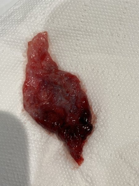 Is this it? Is it finished? (Graphic picture of clot ...