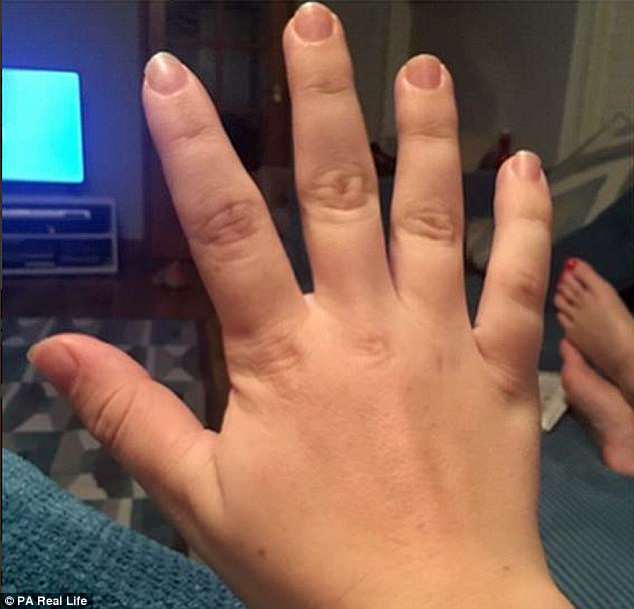 Midwife reveals how her hands and feet wouldnt stop growing  because ...