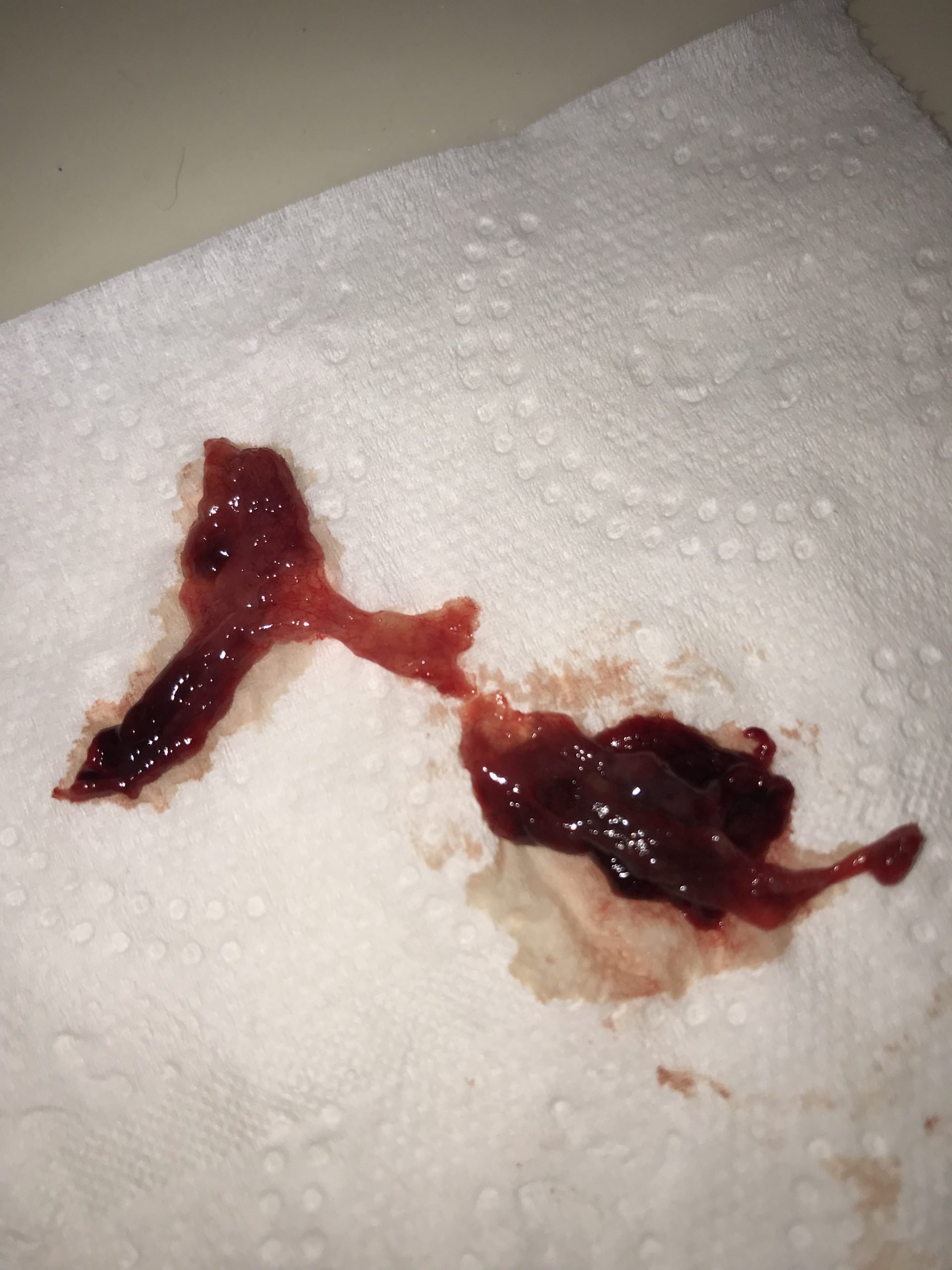 Miscarriage or regular blood clot? (Gross pic)