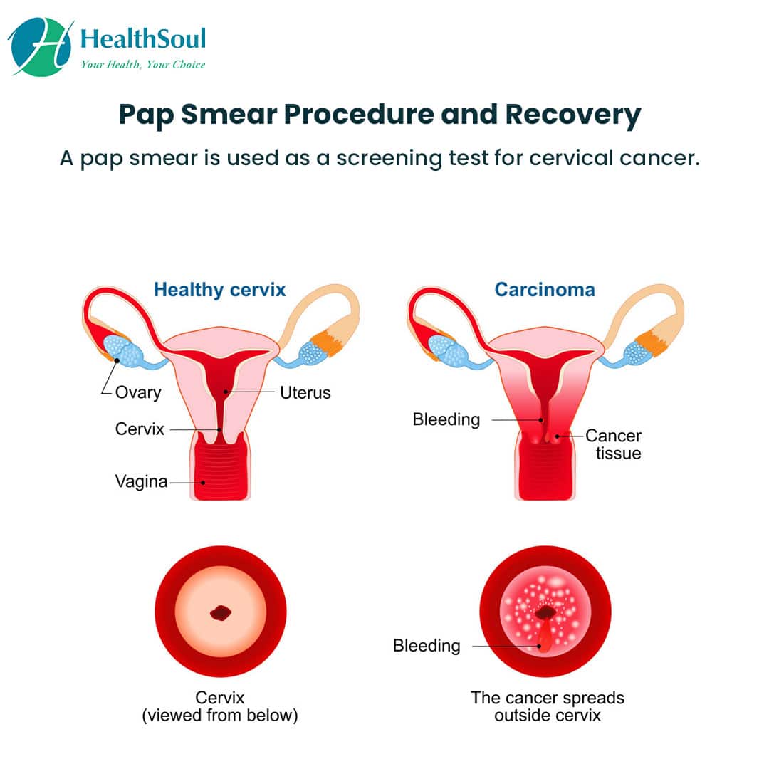 Pap Smear: Procedure and Recovery