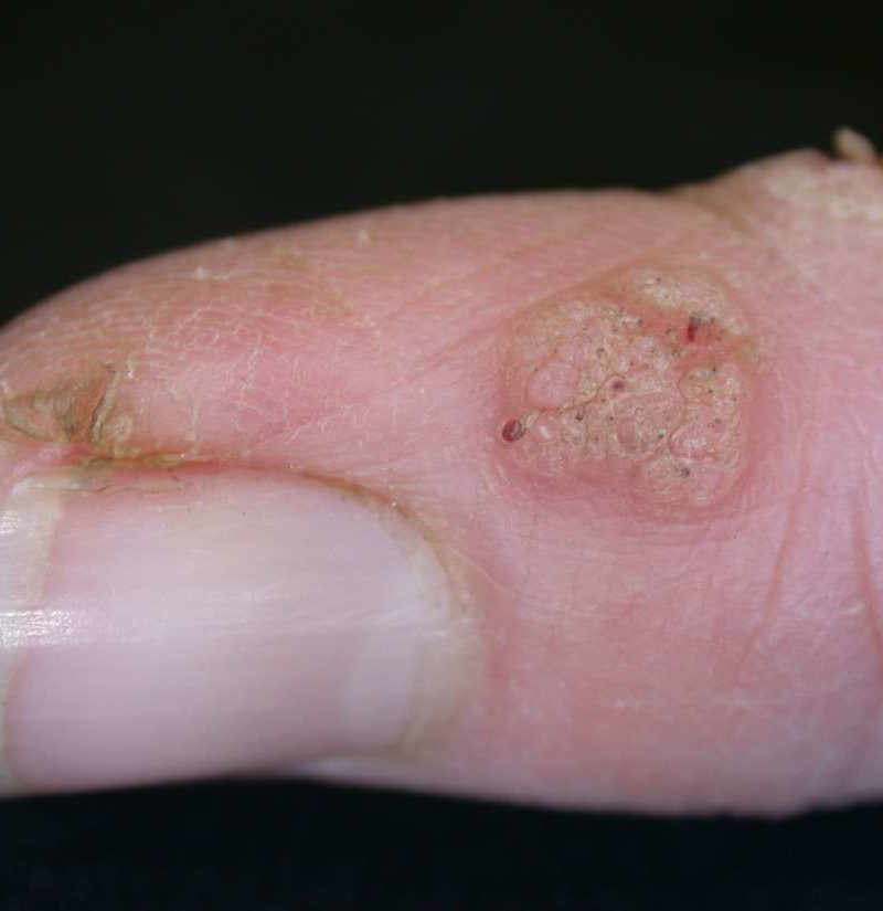 Periungual warts: Pictures, treatment, and prevention