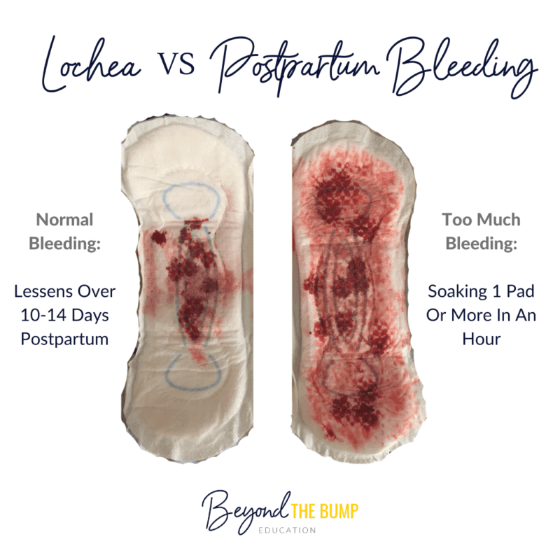 Postpartum Bleeding: What To Expect Postpartum