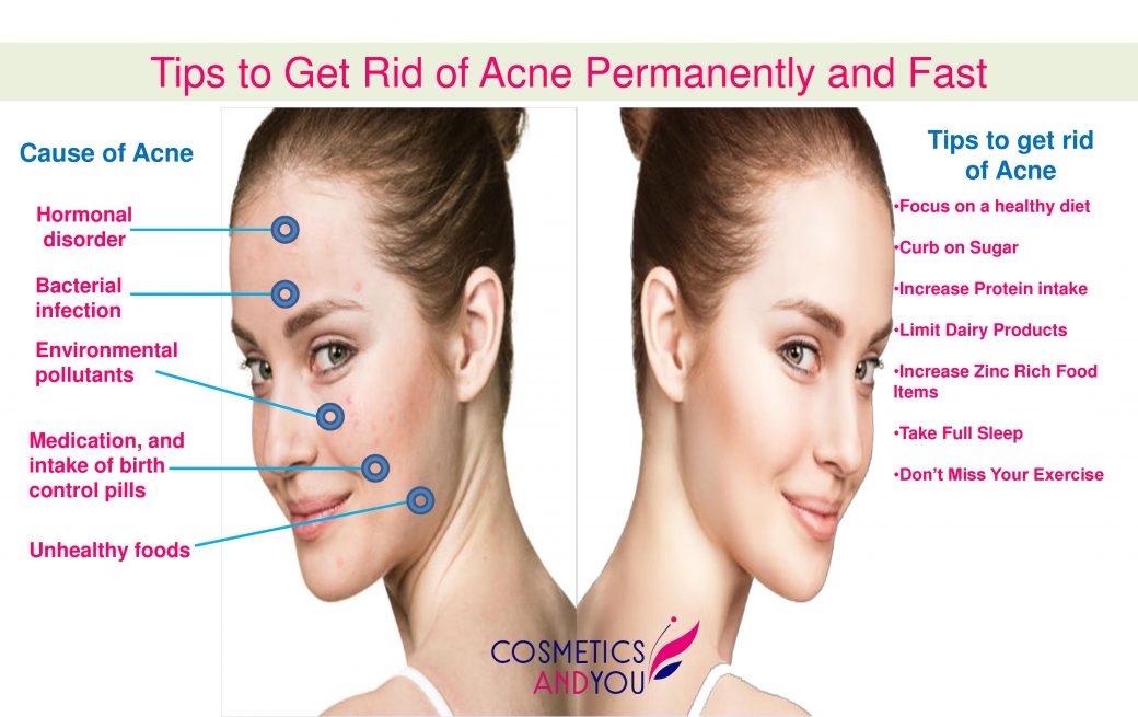 Tips to Get Rid of Acne Permanently and Fast
