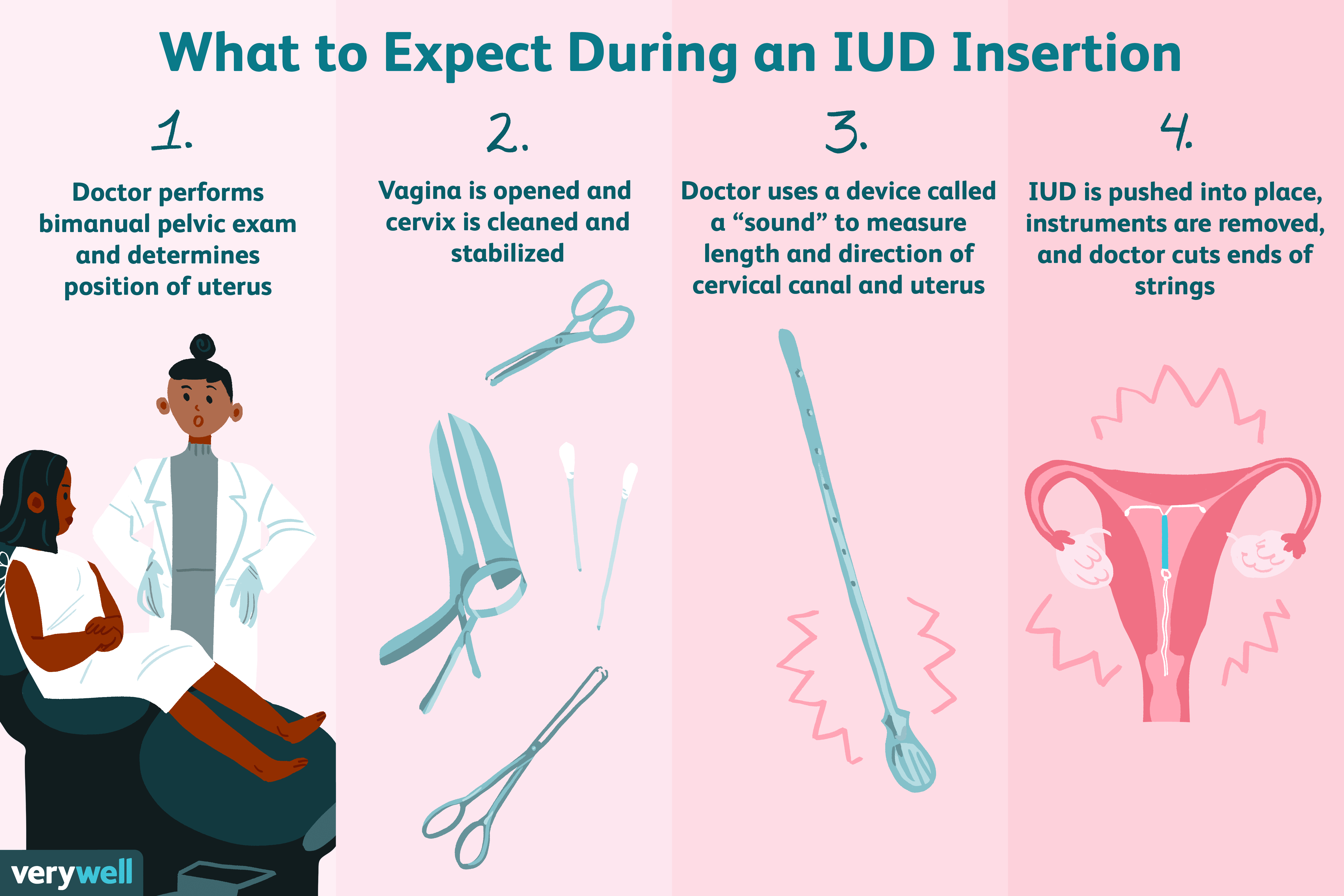 What to Expect During an IUD Insertion