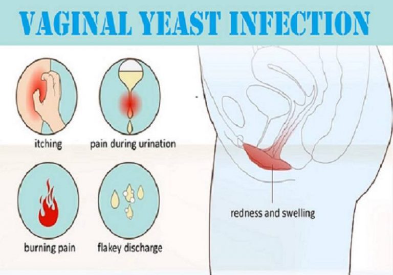 Why Do I Get Recurring Yeast Infections After Period ...