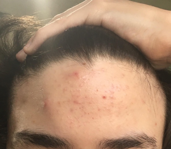 Why do I have pimples on my forehead?
